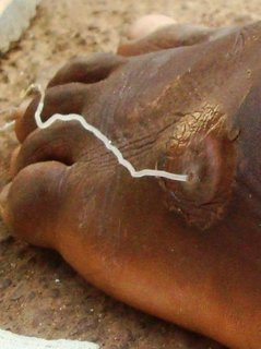 147269-guinea-worm-4-tamale-ghana-thumbnail2.jpg